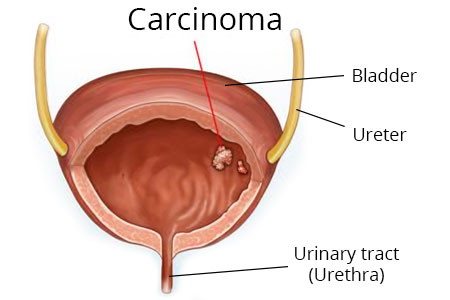 کارسینوم مثانه در تصویر مشاهده می‌شود.