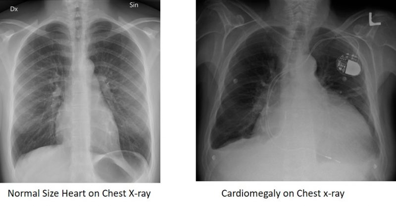 تشخیص بزرگ شدن قلب در تصویر اشعه ایکس