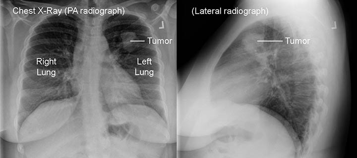 عکس سرطان ریه بدخیم با اشعه ایکس