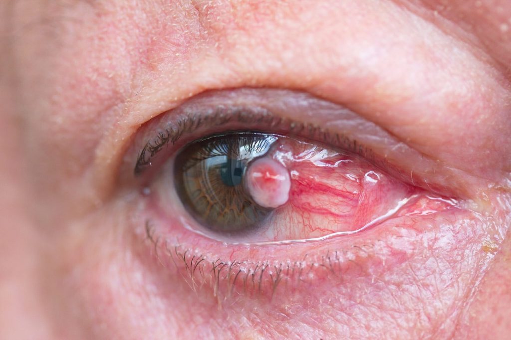 تومور ملتحمه چشم چیست