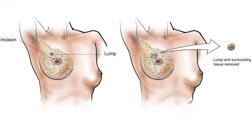 لامپکتومی برای درمان سرطان سینه