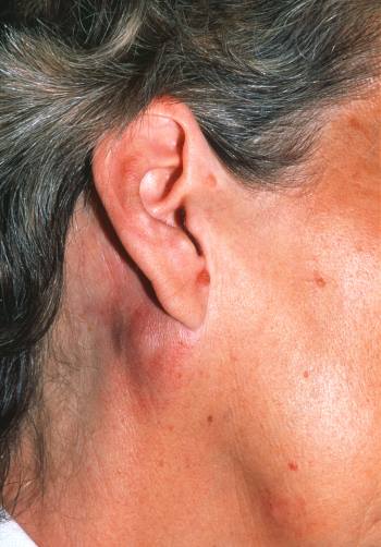 تورم در ناحیه گوش نشان‌دهنده‌ی سرطان لنفوم