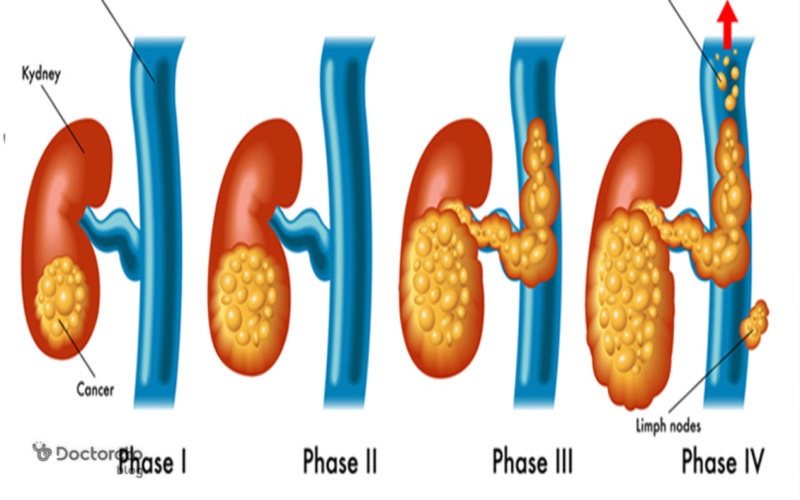 مراحل سرطان سلول کلیه چیست؟
