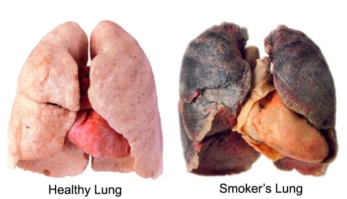 تفاوت ریه فرد سالم با فرد سیگاری