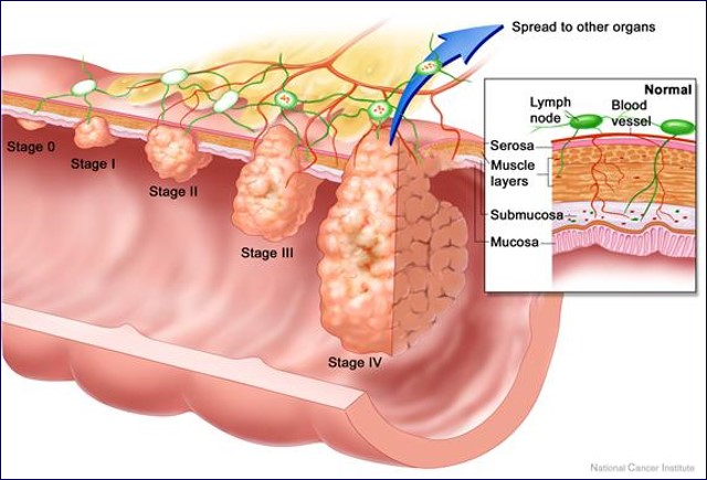 مراحل سرطان روده کوچک