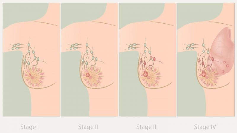 درمان سرطان سینه در مراحل مختلف