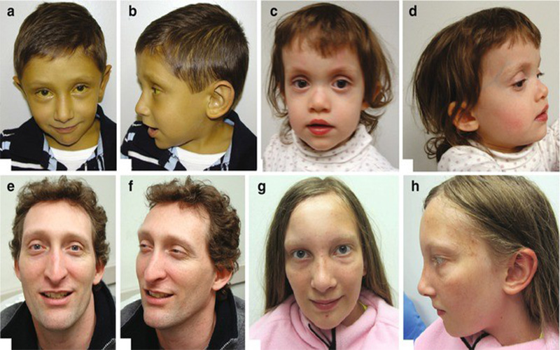 ویژگی‌های چهره بیماران مبتلا به سندروم آلاژیل تغییر می‌کند. 