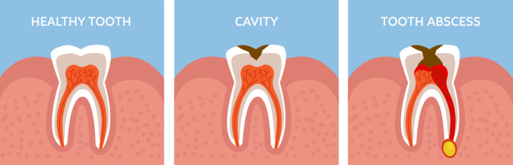 علت‌ های مختلف دندان درد
