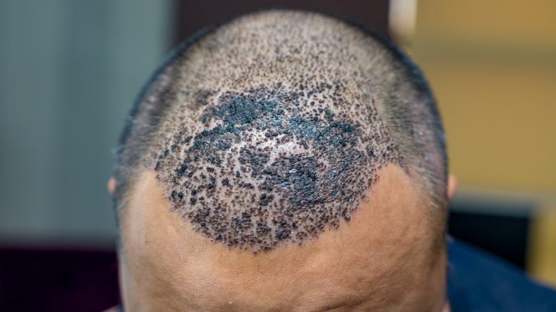 عفونت بعد از کاشت مو