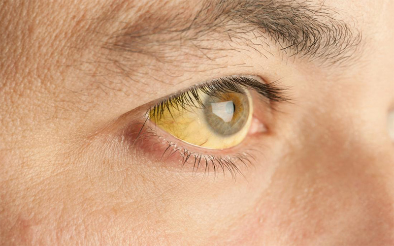 اصلی‌‌ترین علامت سندروم ژیلبرت زردی پوست و گاهی زرد شدن سفیدی چشم است.