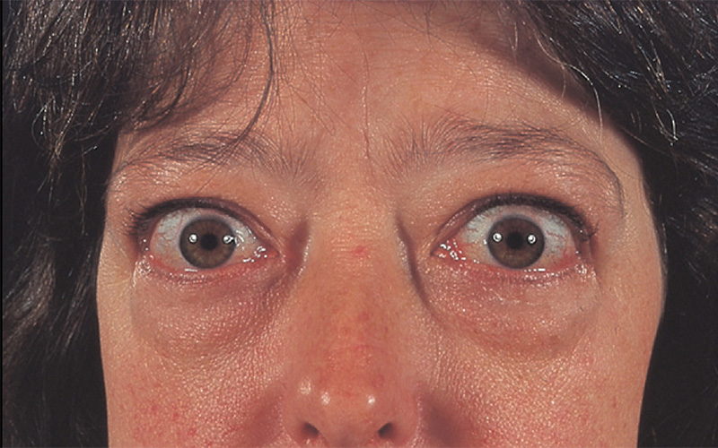 برخی بیماران مبتلا به گریوز ممکن است دچار علائم گریوز چشمی شوند.