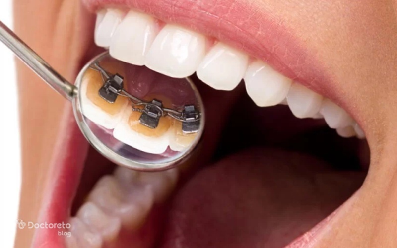 ارتودنسی لینگوال یا ارتودنسی پشت دندانی چیست؟