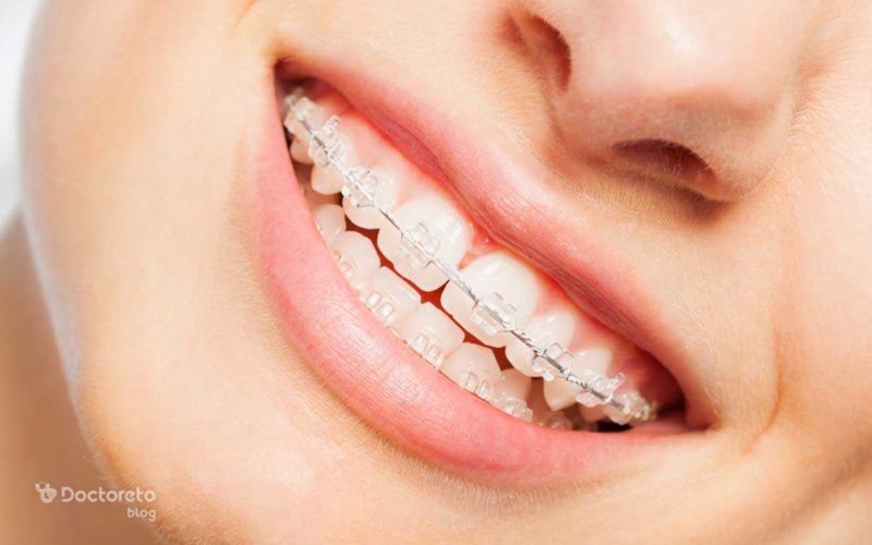 ارتودنسی دیمون، جدیدترین روش ارتودنسی ثابت دندان