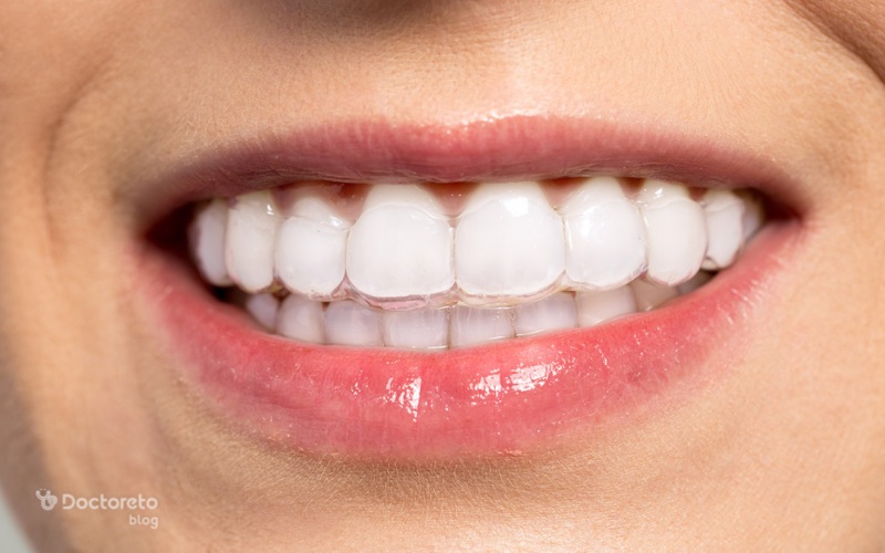 ارتودنسی نامرئی (اینویزیلاین)، بهترین روش زیبایی دندان برای بزرگسالان