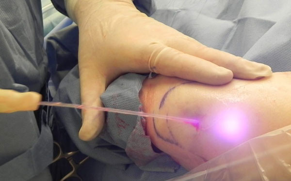 یکی از روش‌های لیفت بازو که نیازی به جراحی پیچیده ندارد لیفت بازو با لیزر است.