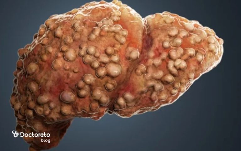 مراحل فیبروز کبدی؛ علائم، دلایل و درمان آن