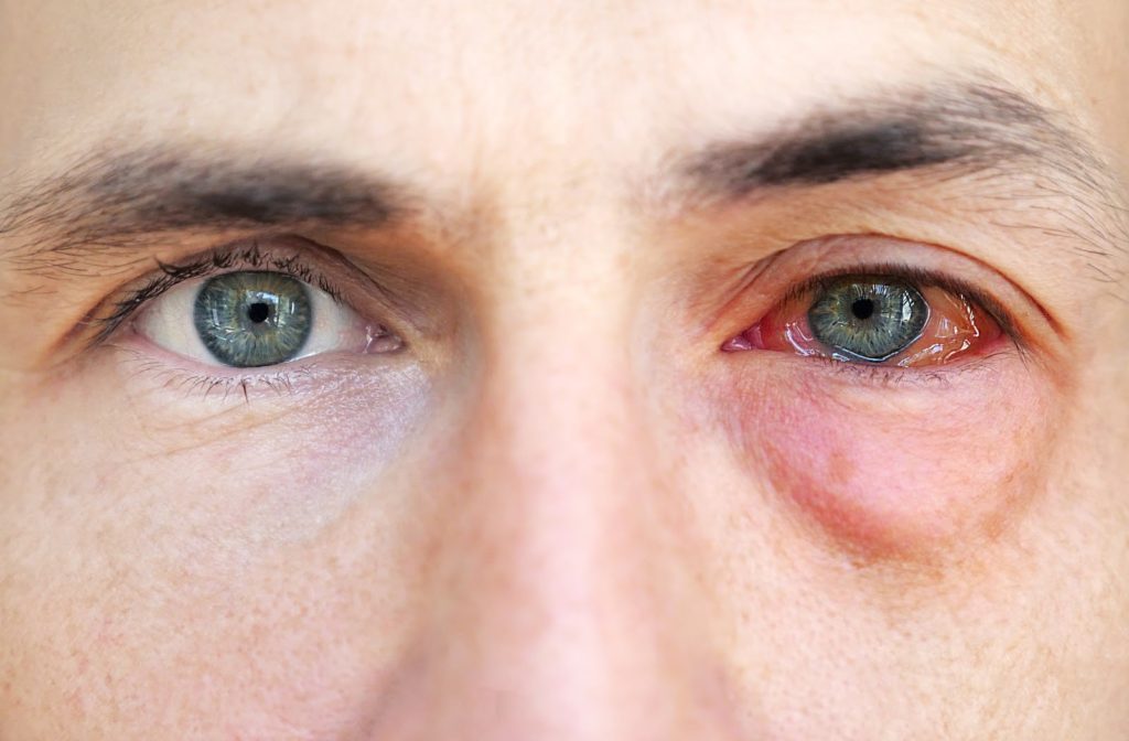 آلرژی چشمی یکی از انواع آلرژی است. 