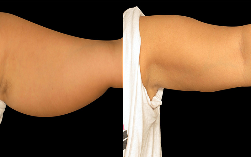 با استفاده از این روش می‌توان افتادگی پوست خفیف تا متوسط در ناحیه بازو را از بین برد. 