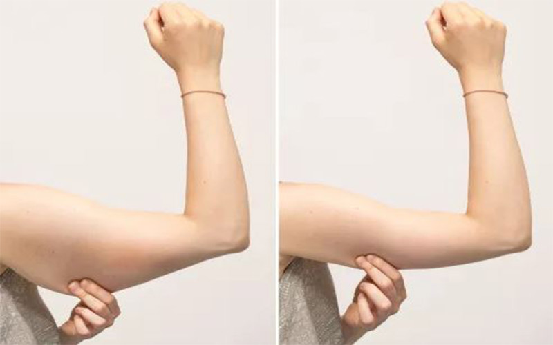 اگر میزان افتادگی پوست بازو مشابه این تصویر باشد، می‌توان با استفاده از دستگاه آر اف لیفتینگ بازو را انجام داد. 