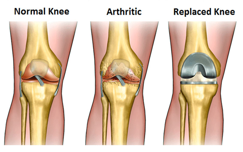 به دلیل مشکلات مفصلی مانند آرتریت مفاصل زانو آسیب دیده و باید مفصل مصنوعی جایگزین شود. 