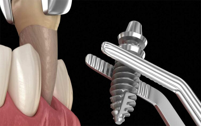 ایمپلنت دندانی یک روزه در یک جلسه ساخته می شود و روکش موقت روی آن قرار می گیرد. 