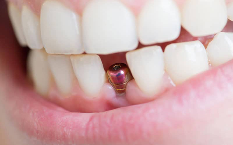 در برآورد قیمت ایمپلنت دندان هزینه روکش باتوجه‌به جنس آن تعیین می‌شود. 