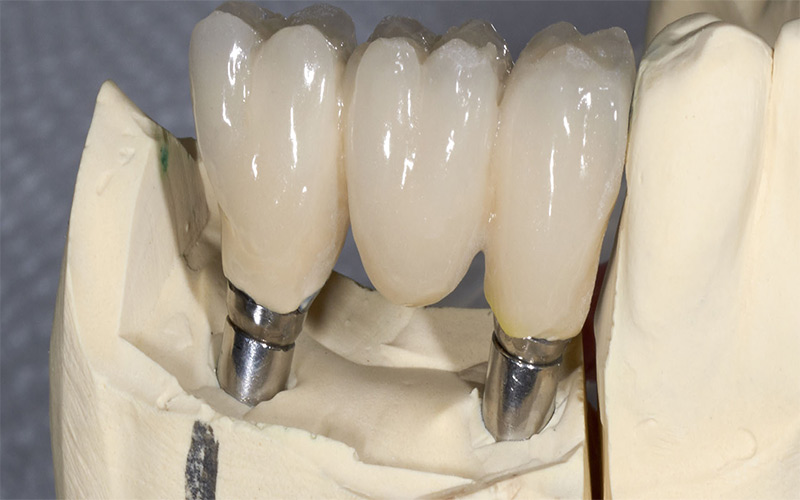 Implant Hàn Quốc được làm từ chất liệu titan và liên kết tốt với xương hàm. 