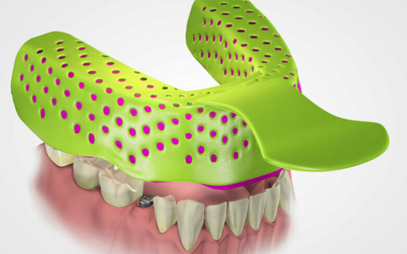 Trong quá trình tạo khuôn, các chi tiết phải được quan sát để cấy ghép vừa khít với răng tự nhiên. 