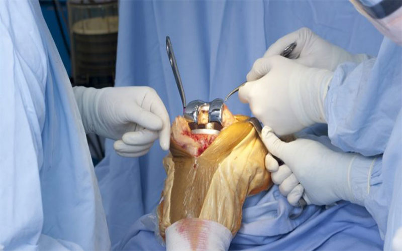 در عمل تعویض مفصل زانو برشی روی زانو ایجاد شده و پروتز جایگزین مفصل آسیب‌دیده می‌شود.