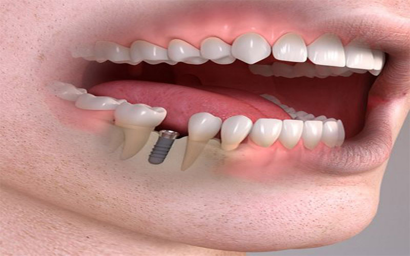 Cấy ghép lấp đầy khoảng trống của răng và làm tăng thêm vẻ đẹp của bạn.