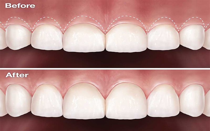 Phẫu thuật nướu được thực hiện vừa để làm cho răng đẹp hơn vừa để điều trị các bệnh về nướu. 