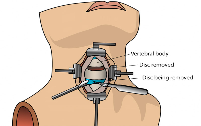 در جراحی دیسک گردن برشی روی گلو ایجاد شده و به مهره‌ها و دیسک دسترسی پیدا می‌شود. 