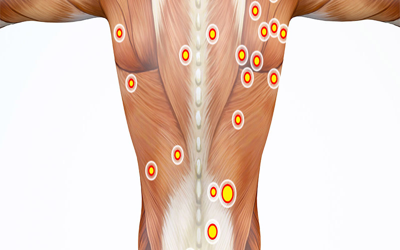 گره های عضلانی می‌توانند در هر قسمت بدن ایجاد شوند. 