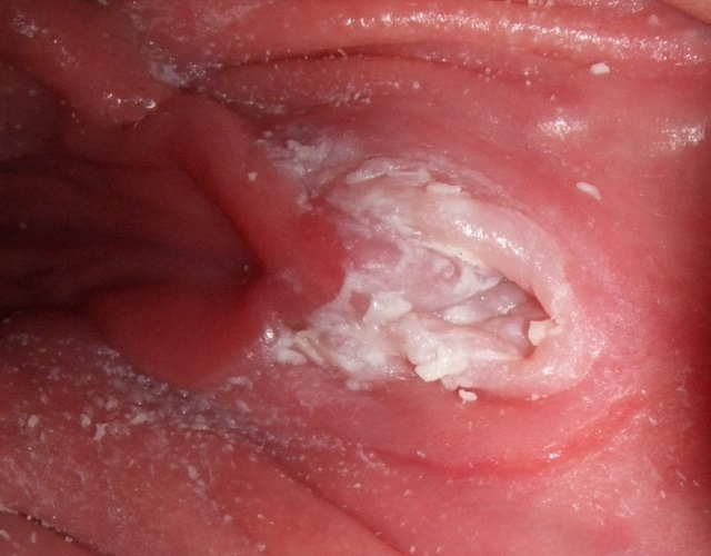 عفونت قارچی واژن و ترشحات آن