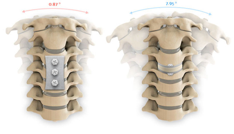 انواع جراحی دیسک گردن