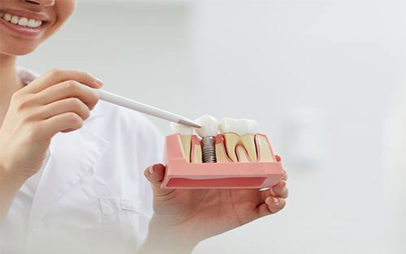 Tất cả các loại implant của Mỹ đều có chất lượng rất cao và độ bền cao.