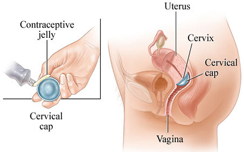 کلاهک دهانه رحم به اسپرم کش آغشته شده و درون واژن روی دهانه رحم قرار می‌گیرد.