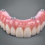 کاشت دندان به روش all-on-4، بهترین روش ایمپلنت کامل فک بالا و پایین