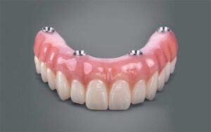 کاشت دندان به روش all-on-4
