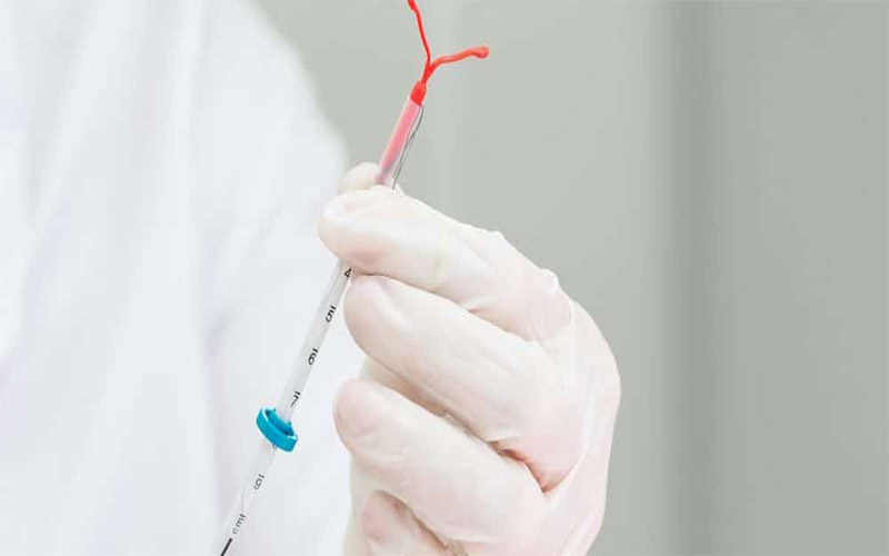 متخصص زنان به کمک لوله اپلیکاتور IUD هورمونی را داخل رحم قرار می‌دهد. 