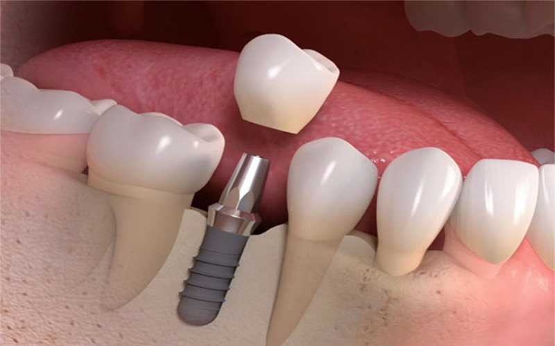 روکش ایمپلنت دندان از نظر نحوه اتصال به دو نوع پیچ‌دار و سیمانی تقسیم می‌شوند.