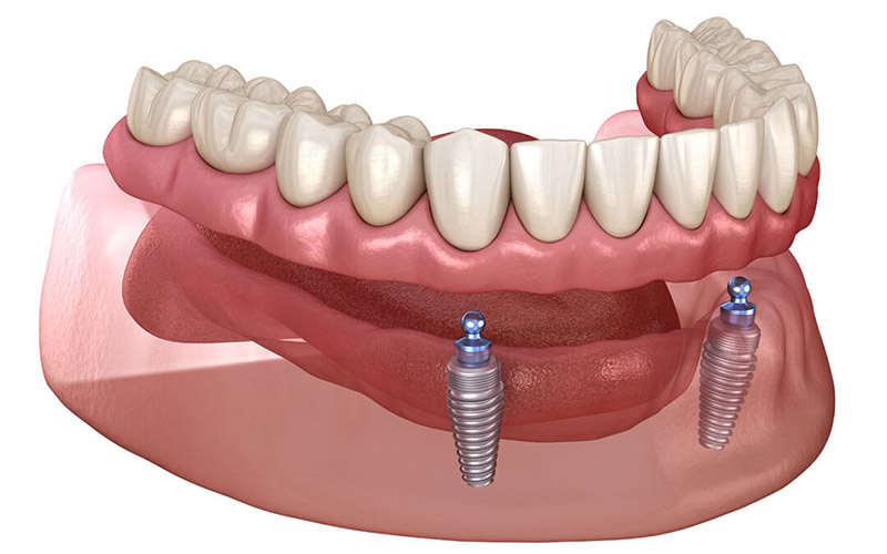 Phục hình nhân tạo được cố định bằng một số implant ở hàm trên và hàm dưới và không di chuyển. 