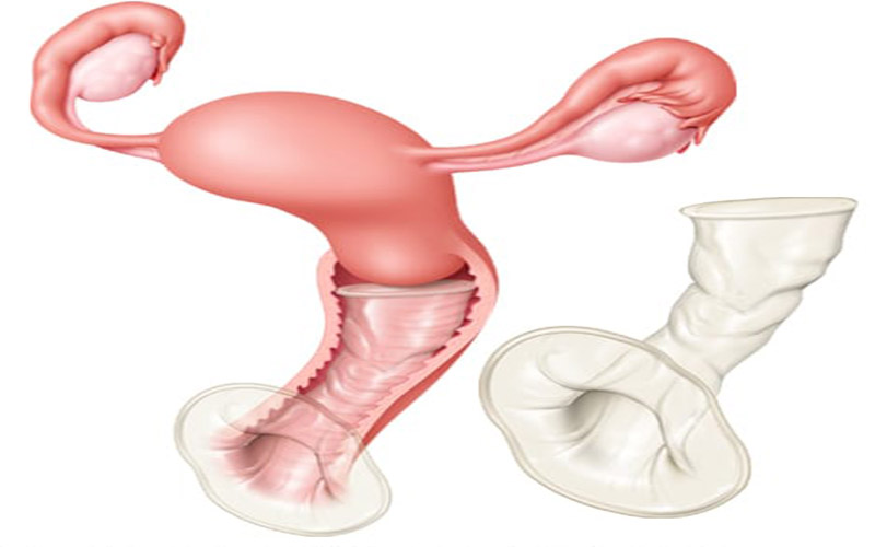 کاندوم زنانه داخل واژن قرار گرفته و حلقه انتهای آن نزدیک دهانه رحم ثابت می‌شود. 