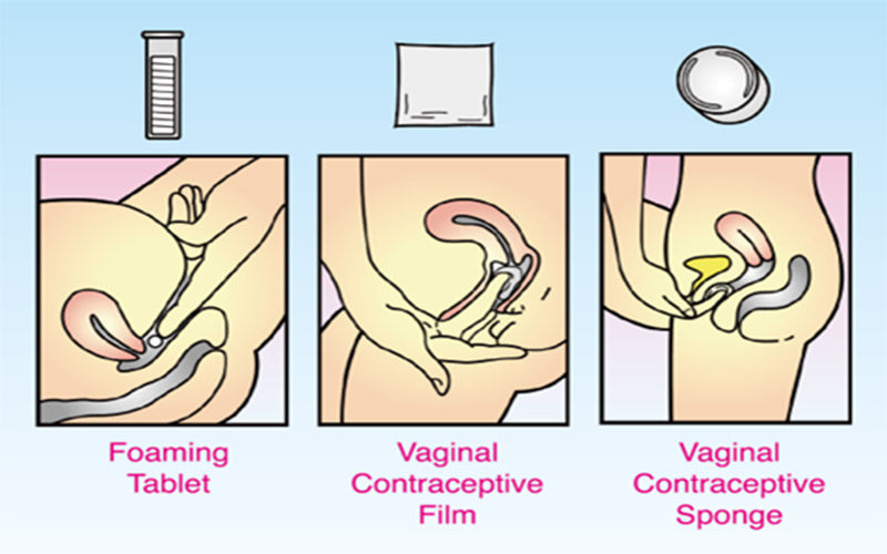 ماده اسپرم‌کش را باید با انگشت یا اپلیکاتور وارد واژن کنید.