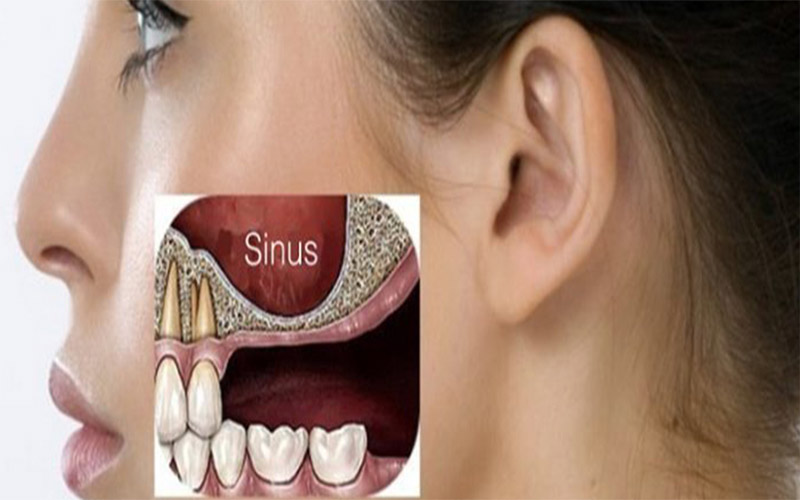 ماده استفاده شده و میزان فضی خالی استخوان فک بالا در قیمت جراحی سینوس لیفت تاثیر دارند.