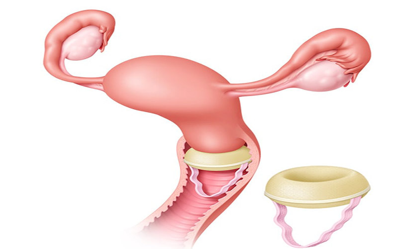اسفنج ضد بارداری را باید قبل از رابطه جنسی داخل واژن قرار داد تا دهانه رحم را بپوشاند.