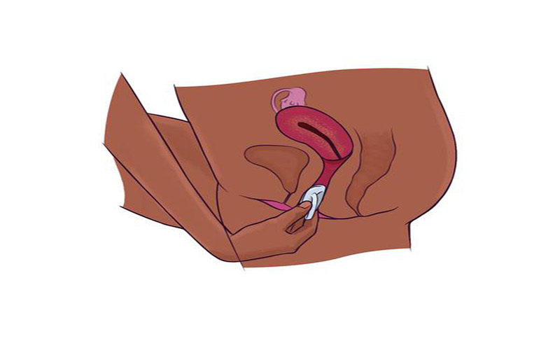 دو طرف اسفنج را به سمت بالا تا کرده و عضلات خود را شل کنید. در این حالت به آرامی با انگشت اسفنج را به داخل واژن وارد کنید.