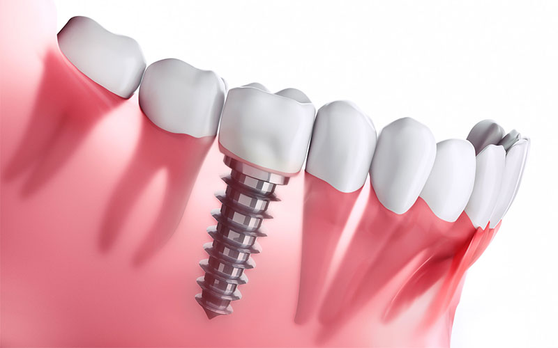 Cấy ghép Biodenta có thể được sử dụng để cấy một răng hoặc tất cả các răng.