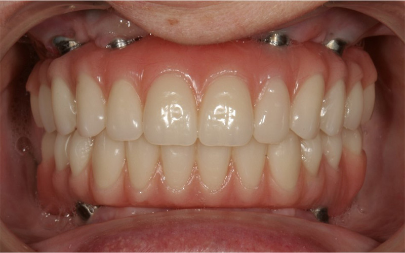 ایمپلنت all-on-4 کاملا شبیه به دندان‌های طبیعی بوده به طور دائمی نصب می‌شود.  