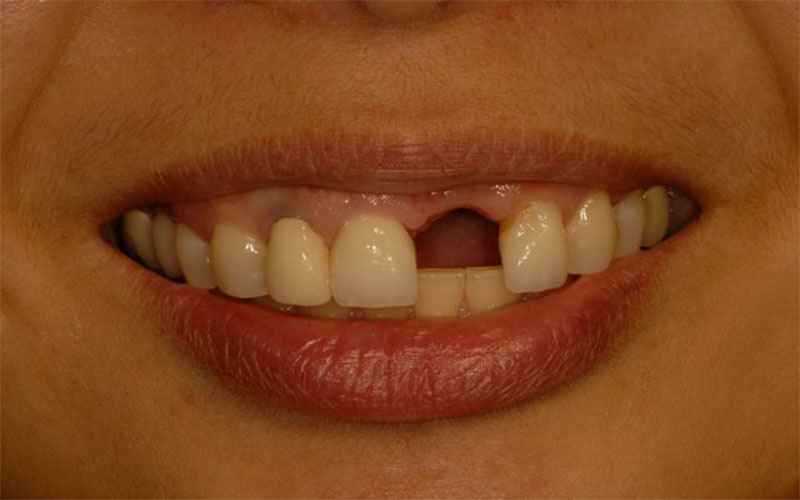 اگر حجم و تراکم استخوان در ناحیه کاشت دندان کم باشد، نیاز به پیوند استخوان خواهد بود.